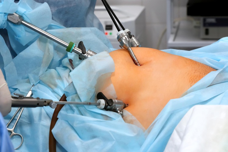 Laparoscopy Surgery