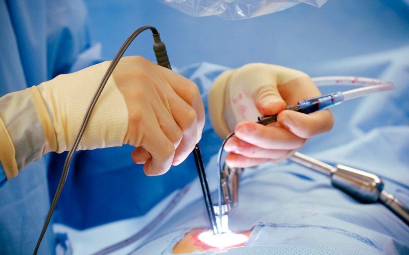 Laparoscopy Surgery